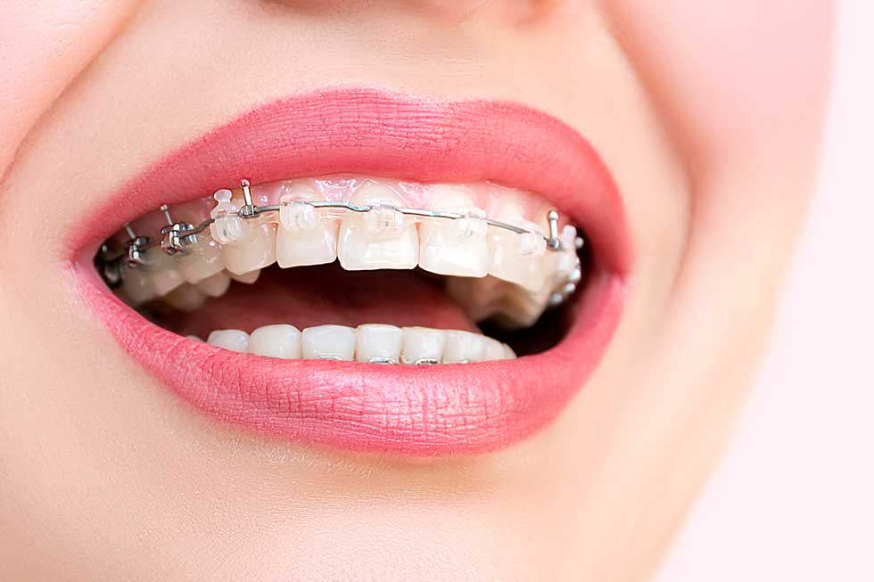 Ceramic Braces In La Crete, AB