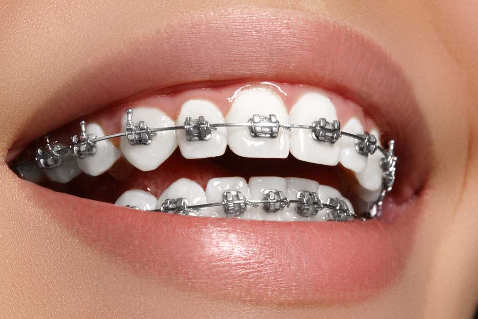 Adult Braces: What Are the Options? Edmonton, AB