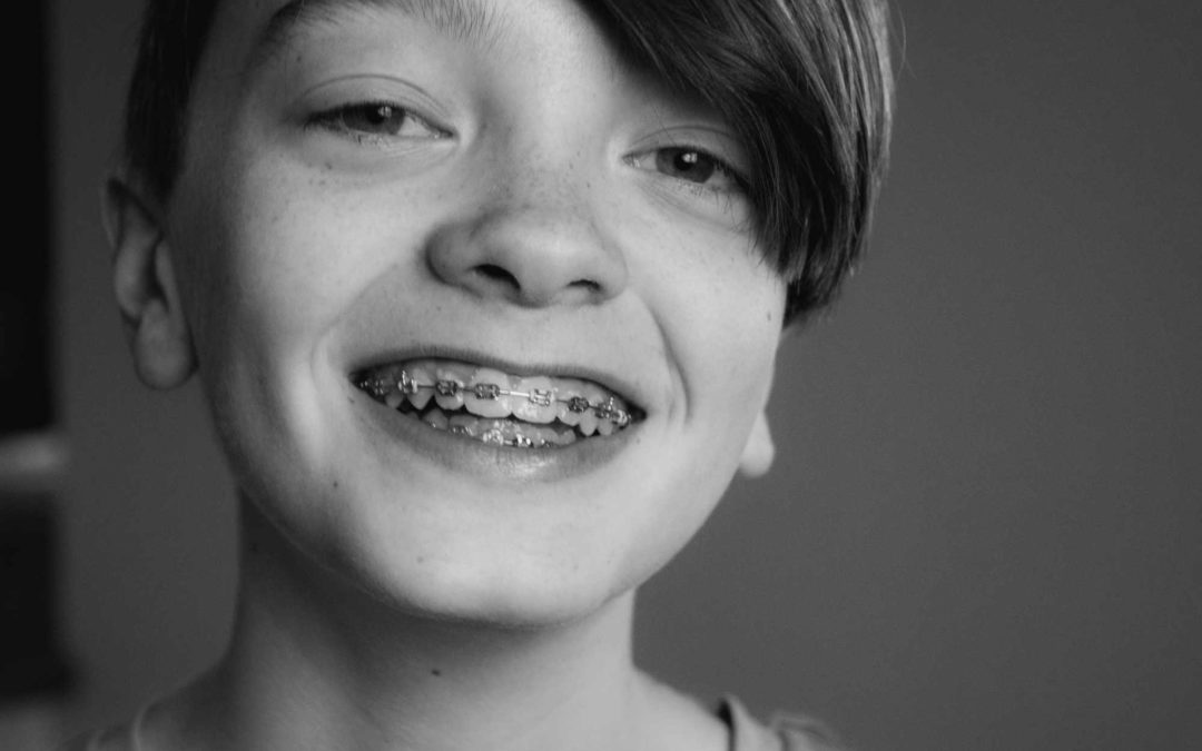 What You Need To Know Before You Get Braces