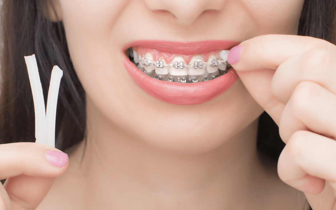 What is Orthodontic Wax and Why Do You Need it?