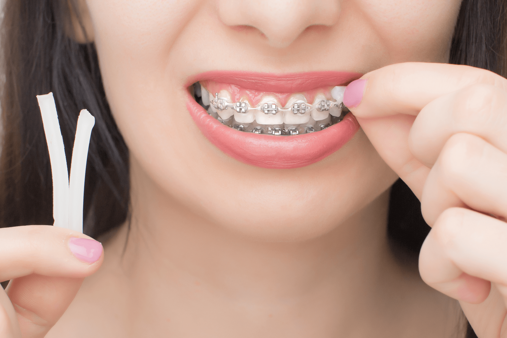 What is Orthodontic Wax and Why Do You Need it? Level Orthodontics