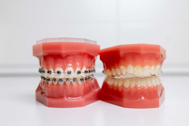 What Should You Do If A Bracket Or Wire Breaks On Your Braces? - Weston  Dental Office