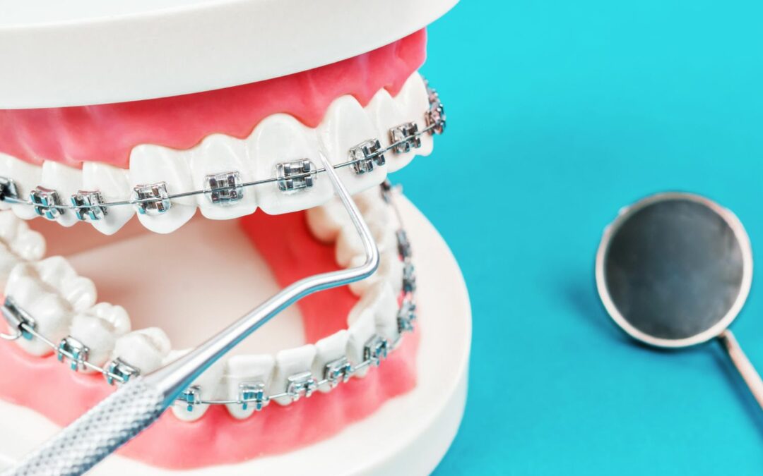 Orthodontic Myths Debunked: Separating Fact from Fiction