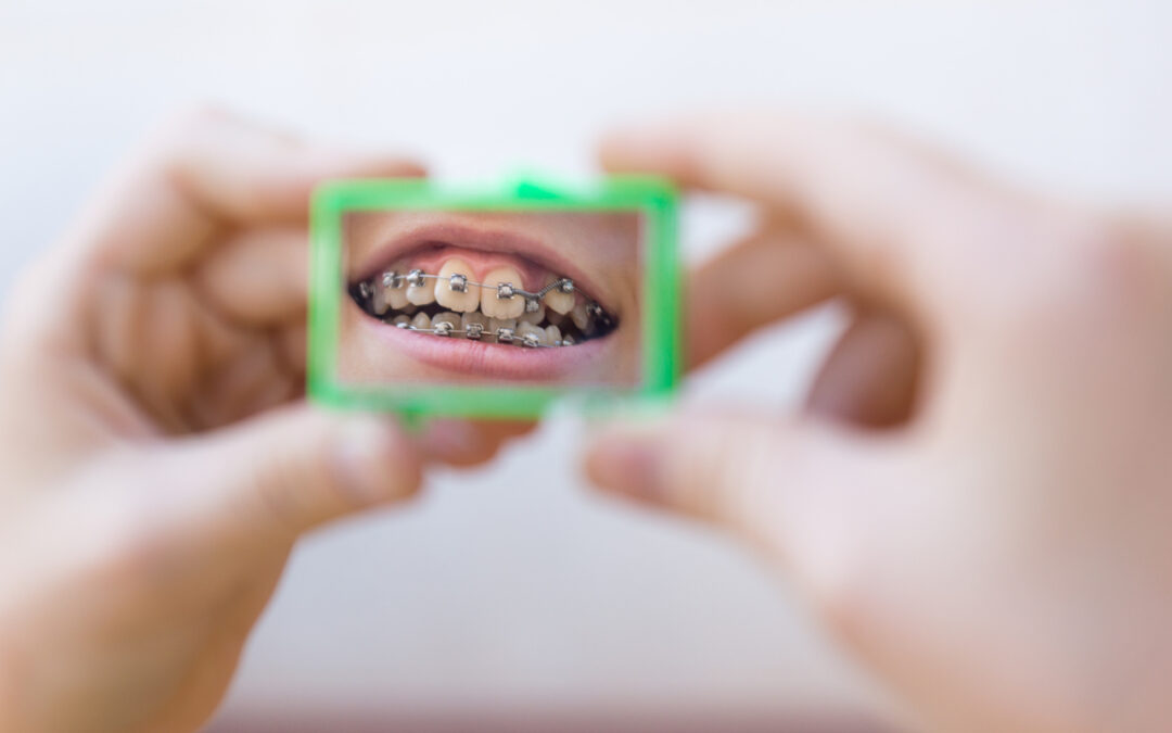 Early Orthodontics Explained: Why Age 7 Is the Perfect Time