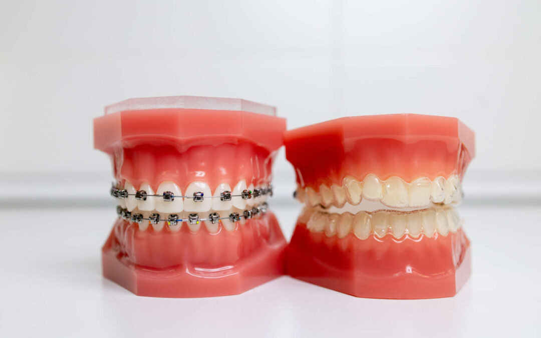 Braces or Clear Aligners? What You Need to Know Before Deciding