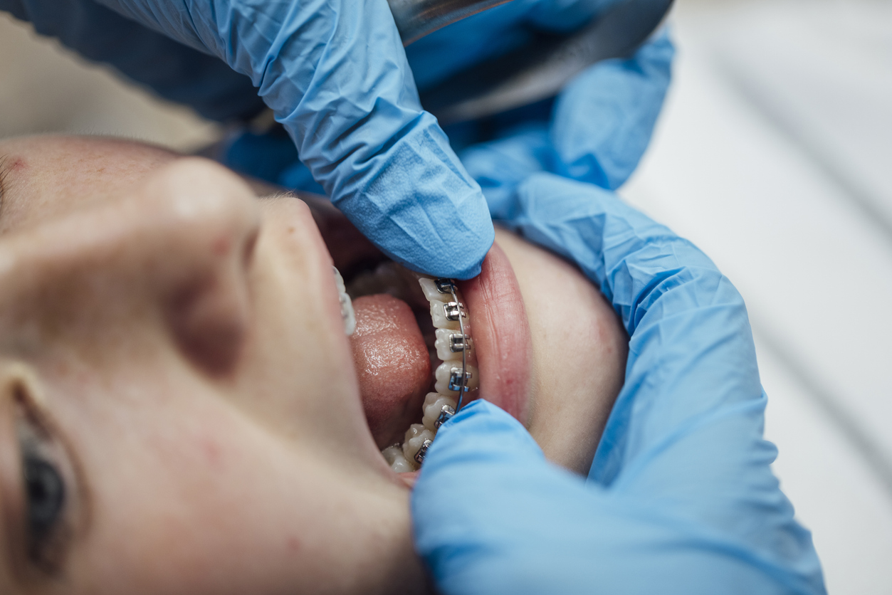 A close up of a teenage girl who is at an orthodontists appointment. She is having her fixed retainer checked and adjusted seeing how her teeth are progressing. The unrecognisable dentist is wearing blue surgical gloves for the examination and is about to add new rubber bands to the braces.